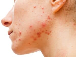 Acne Large 8 300x225