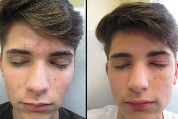 Acne Before After 600x400 1