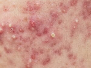 Acne Large 3 300x225