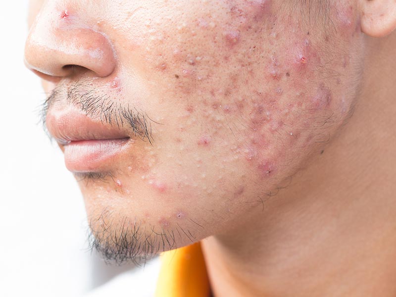 tea tree oil acne scars