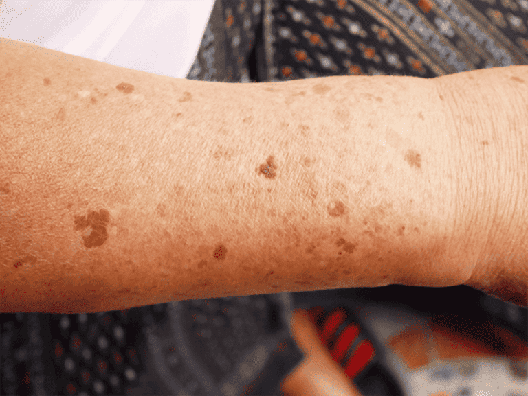 Age-spots-Large_0000_AdobeStock_226542529