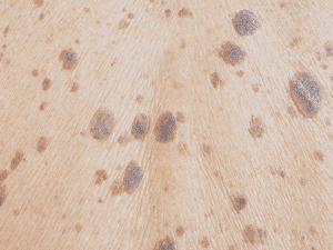 Age-spots-Large_0005_AdobeStock_135524987-300x225