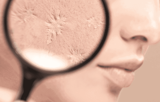 How Effective Is Laser Treatment For Acne Scars E1661499784376