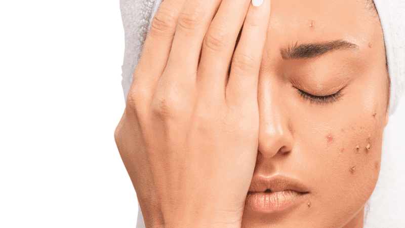 How To Get Rid Of Acne Scars E1653645419340