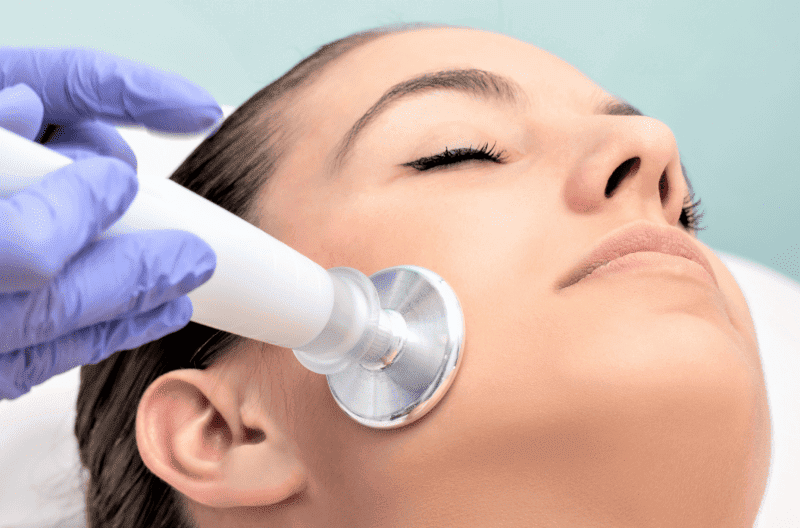 Microdermabrasion To Get Rid Of Acne Scars E1653645230734