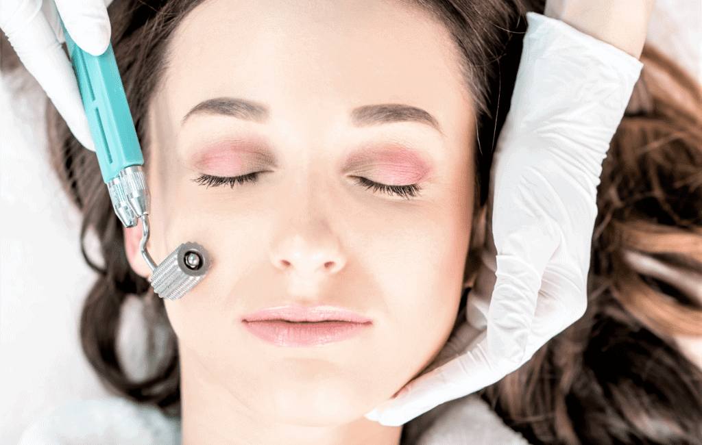 Microneedling For Acne Scars Price