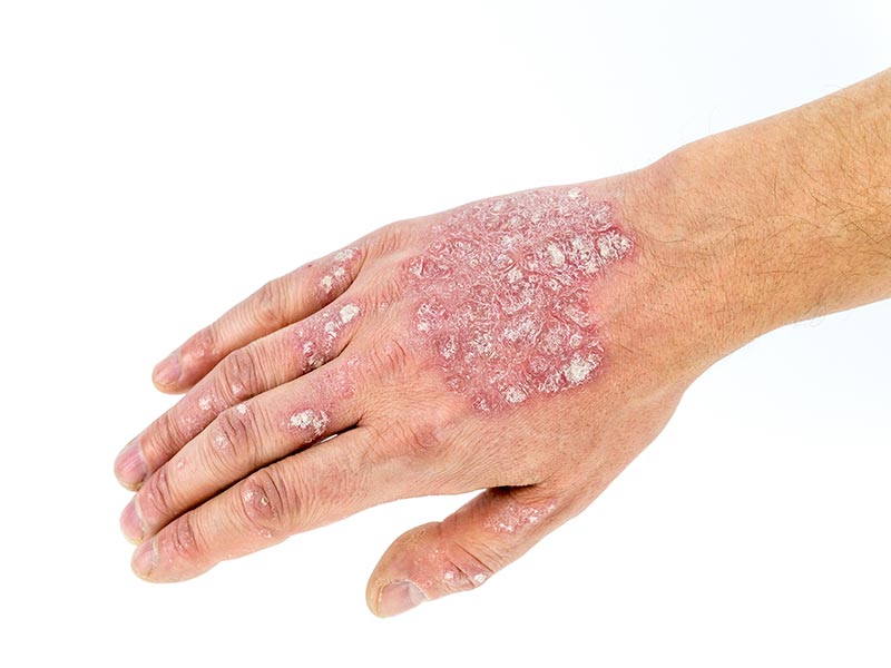 Psoriasis-Large-1