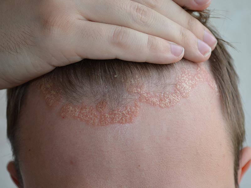 Psoriasis-Large-2
