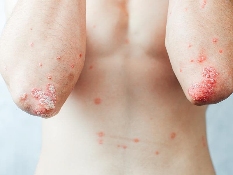 Psoriasis-Large-3