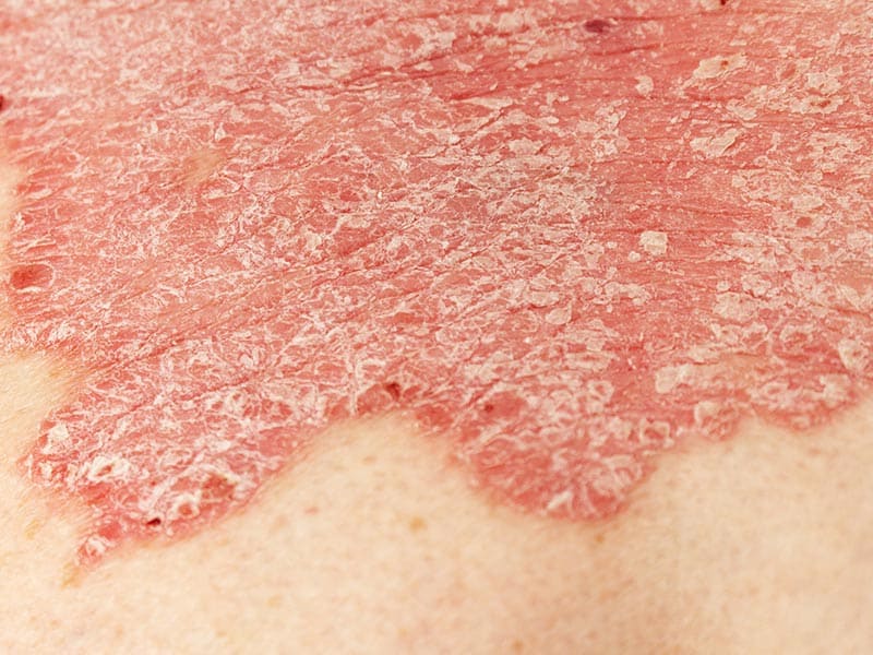 Psoriasis-Large-4