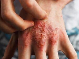 Psoriasis Large 7 300x225