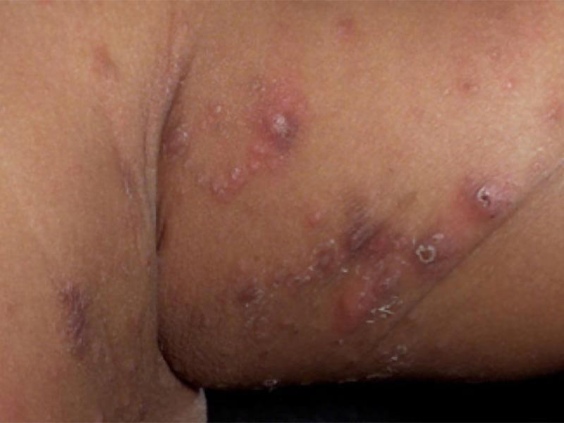 Scabies Rash on Black Skin: Symptoms and Treatment