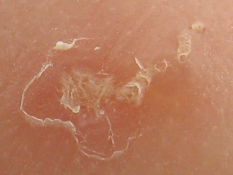 Scabies-Large-4