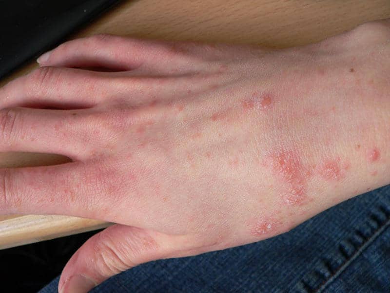 Scabies-Large-6