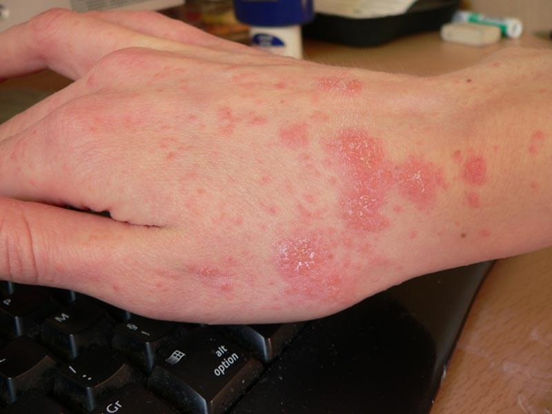 Scabies-Large-7