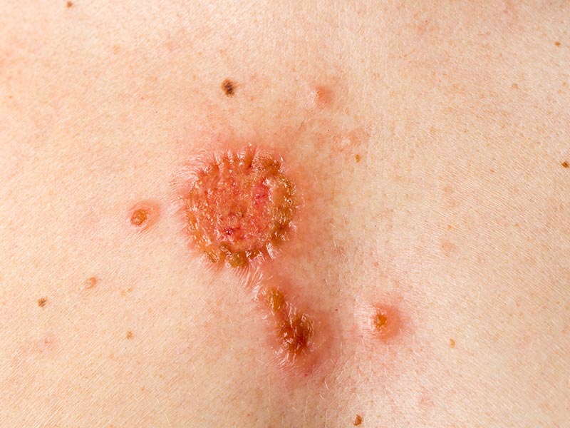 Squamous Carcinoma Large 2