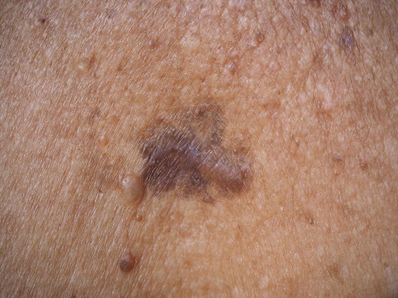 Squamous Carcinoma Large 3