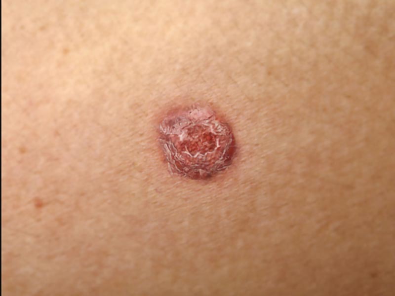 Squamous-Carcinoma-Large-6-1