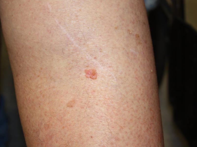 Squamous-Carcinoma-Large-7