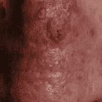 acitinic-k-before-300x200