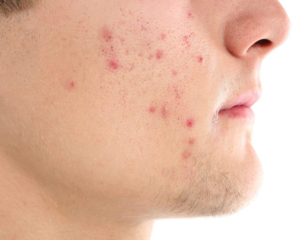 tea tree oil acne scars