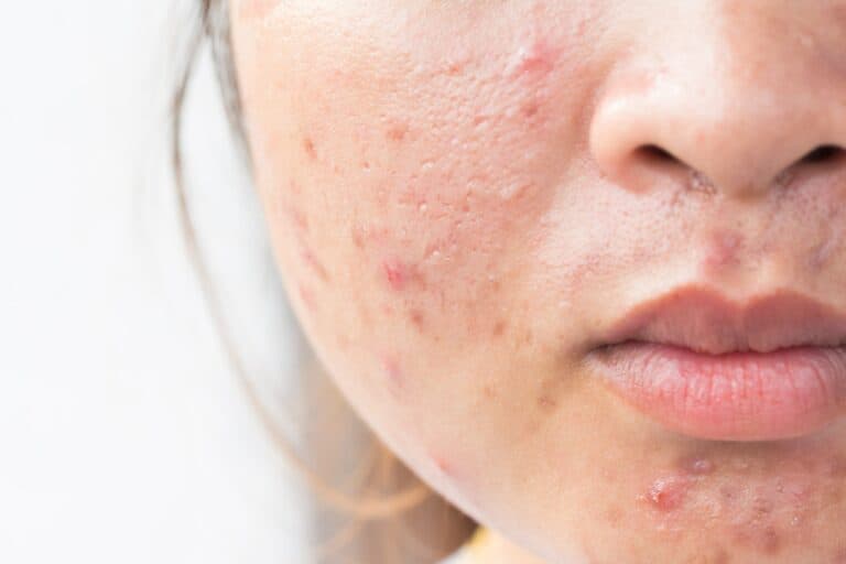acne-scars-2-min