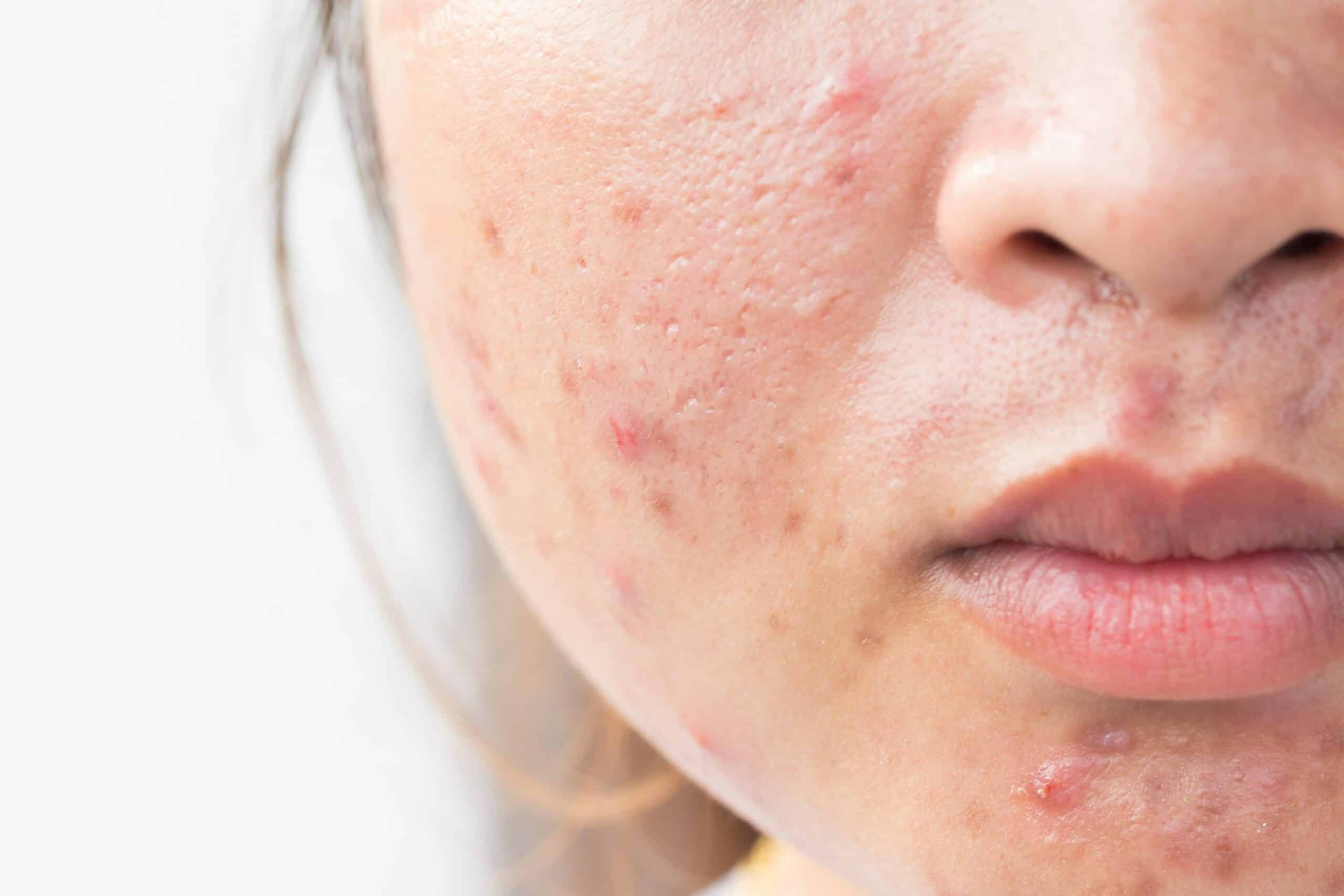 faces with acne vulgaris