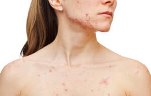 Acne Scars 300x192