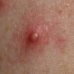 acne-spot-large