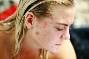 Acne Struggle 300x200