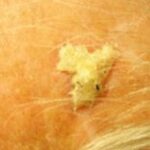 actinic-keratosis-300x158-1