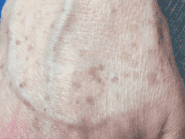 agespots_0001_agespots3