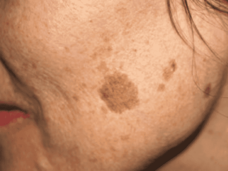 agespots_0002_agespots2