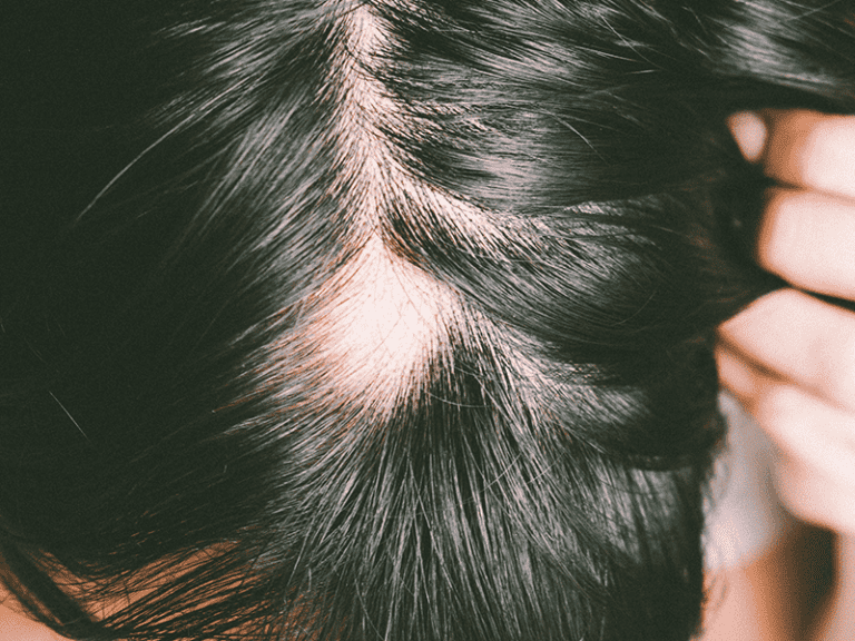 alopecia_0000_AdobeStock_212957221