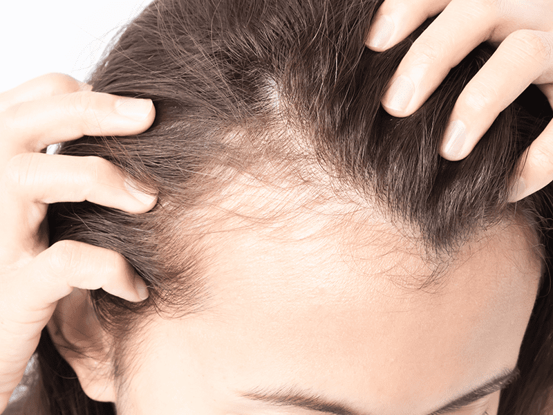 Alopecia 0002 AdobeStock 135718523