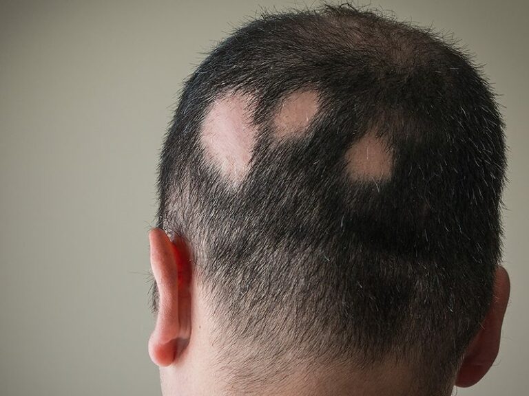 alopecia_0003_AdobeStock_133590978