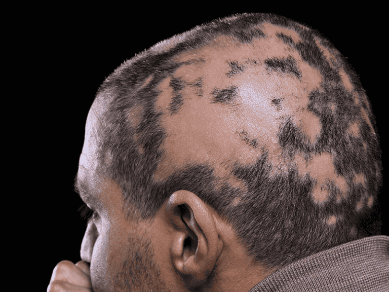 alopecia_0005_AdobeStock_75945057