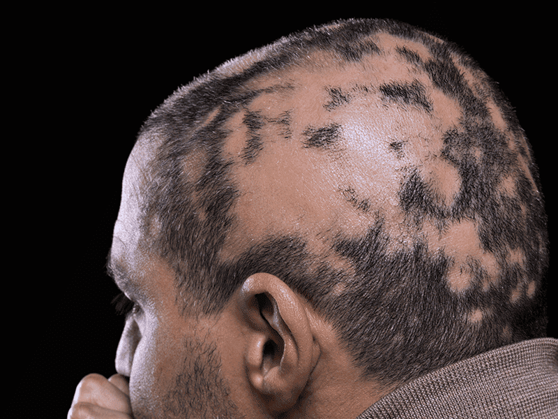 Alopecia 0005 AdobeStock 75945057