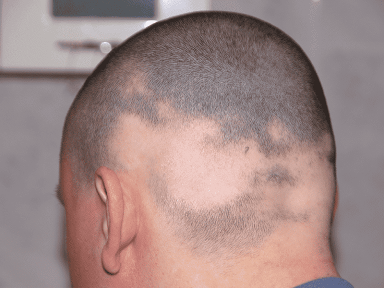 alopecia_0006_AdobeStock_4167055