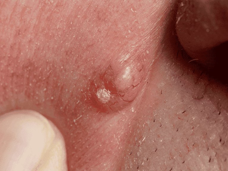 basalcellcarcinoma_0000_Basal-Cell-Carcinoma-6-large