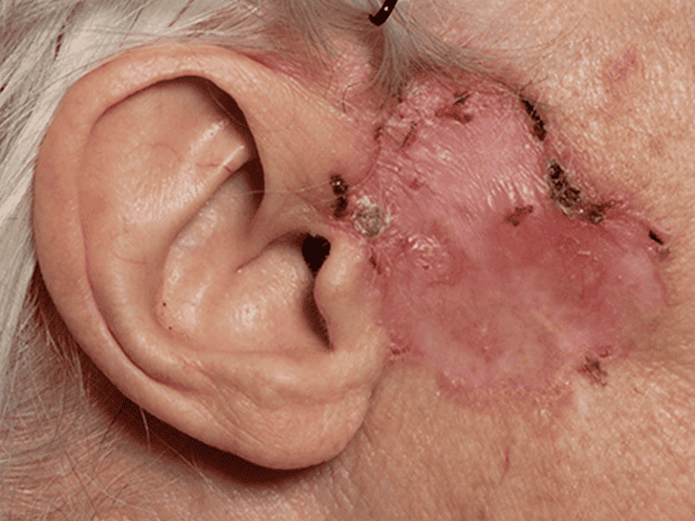 basalcellcarcinoma_0001_Basal-Cell-Carcinoma-5-large
