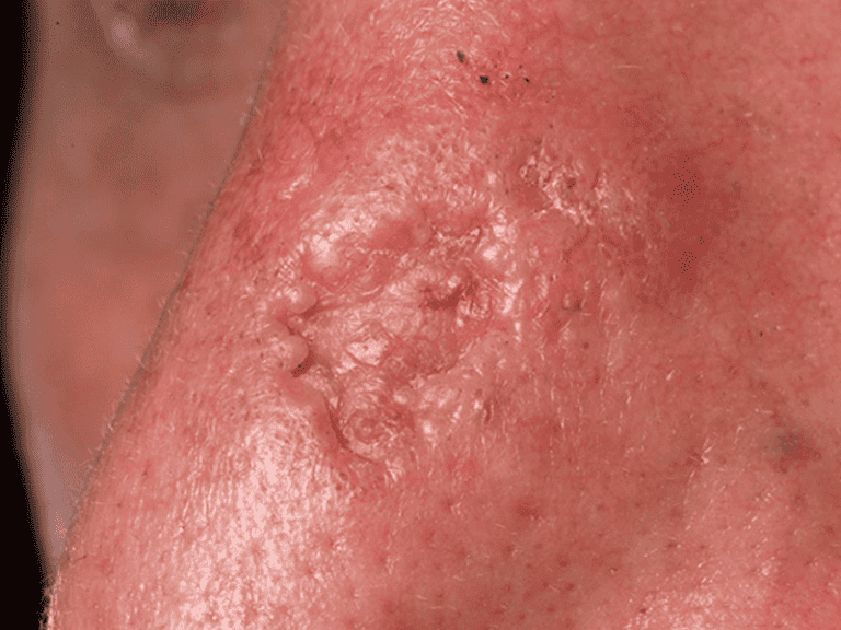 basalcellcarcinoma_0002_Basal-Cell-Carcinoma-4-large