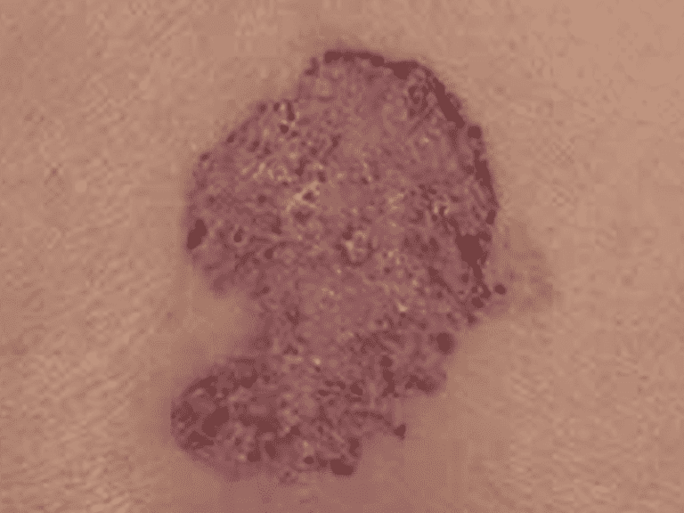 basalcellcarcinoma_0004_Basal-Cell-Carcinoma-2