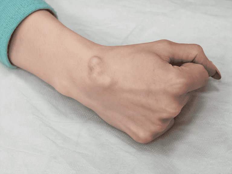 cysts_0000_AdobeStock_269378508