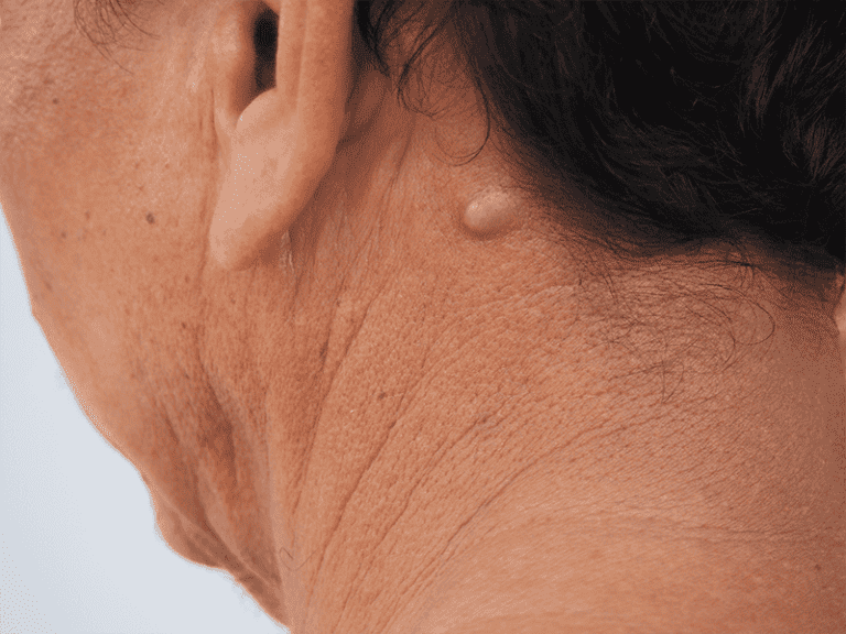 cysts_0001_AdobeStock_246579227