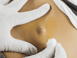 Cysts 0006 AdobeStock 119031311 1 300x225