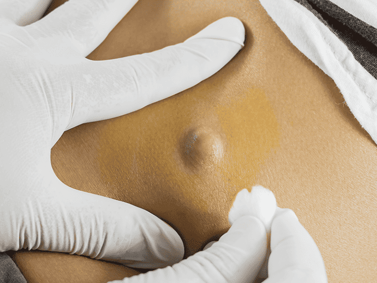 cysts_0006_AdobeStock_119031311-1
