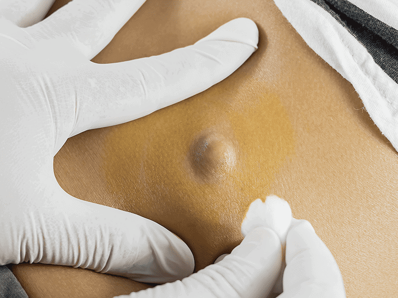Cysts 0006 AdobeStock 119031311 1