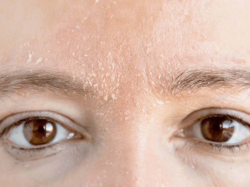 eczema_0000_AdobeStock_224866266