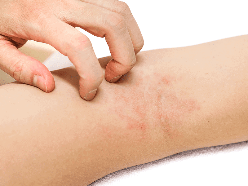 eczema_0001_AdobeStock_176541850